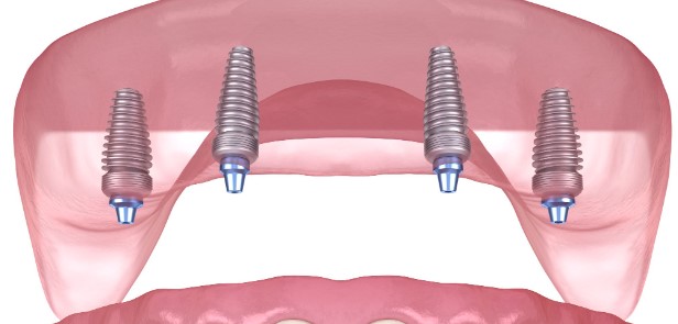 Dental Implants vs. Traditional Dentures