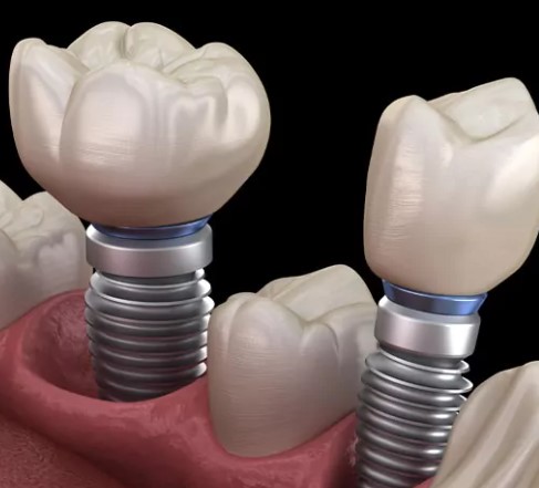 Dental Implants Vs Traditional Dentures, dental prosthetics, implantsupported dentures, fixed dental bridges, removable partial dentures, dental restoration options, missing teeth solutions, tooth replacement alternatives, oral health choices, dental appliance comparison, permanent tooth replacements, removable dentition, jawbone density considerations, dental prosthesis variety, dental treatment options, dental care selection, dental therapy alternatives, dental technology advancements, dental innovation trends, dental procedure contrasts, dental appliance variety, dental modality comparison, dental methodology differences, dental evaluation options, dental expert analysis